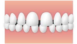 空隙歯列弓(くうげきしれつきゅう) すきっ歯
